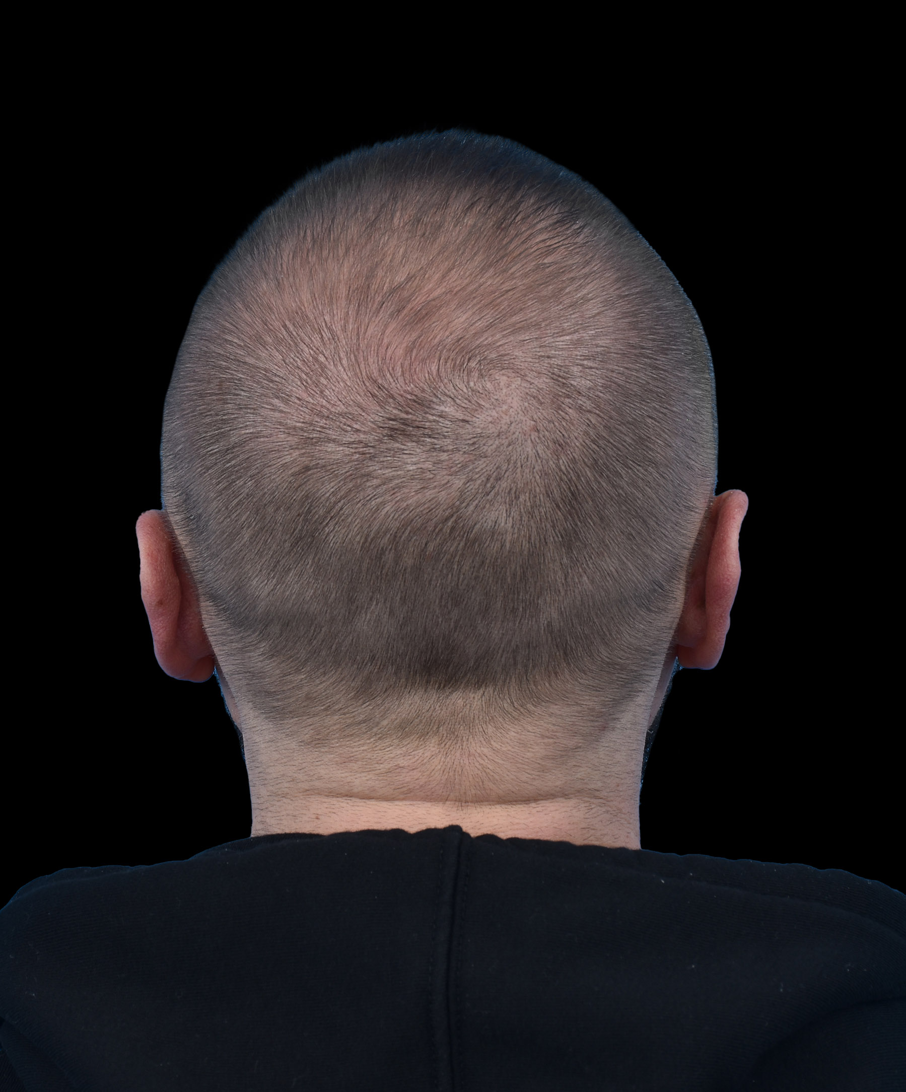 Poprawa przylegania uszu po operacji odstających uszu dr Kołacz Wrocław