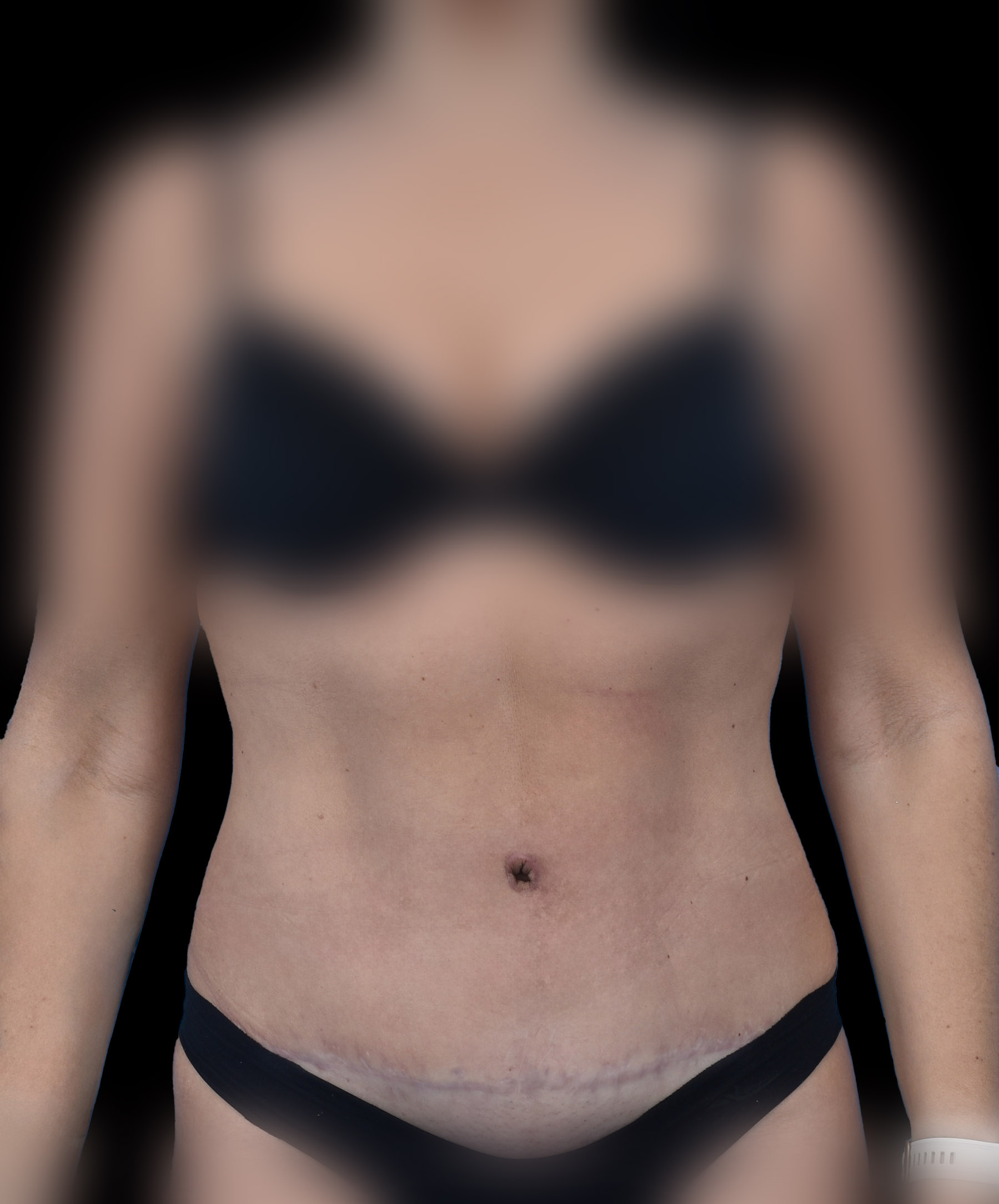 Efekt plastyki brzucha z korekcją rozejścia mięśni prostych wykonanej przez dr Kołacza we Wrocławiu