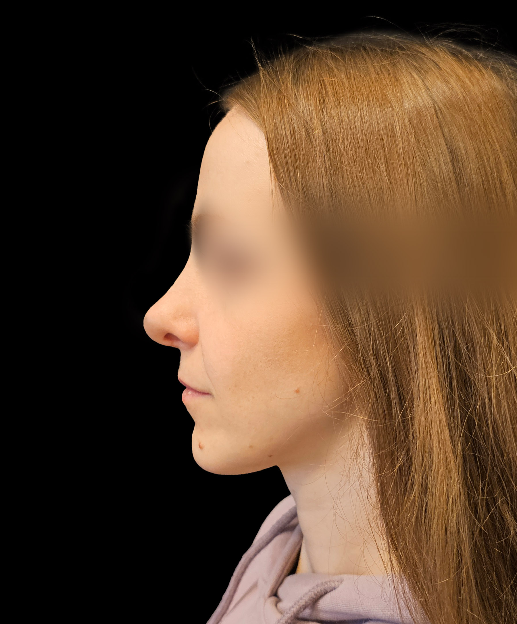 Profil nosa po plastyce wykonanej przez dr Kołacza we Wrocławiu