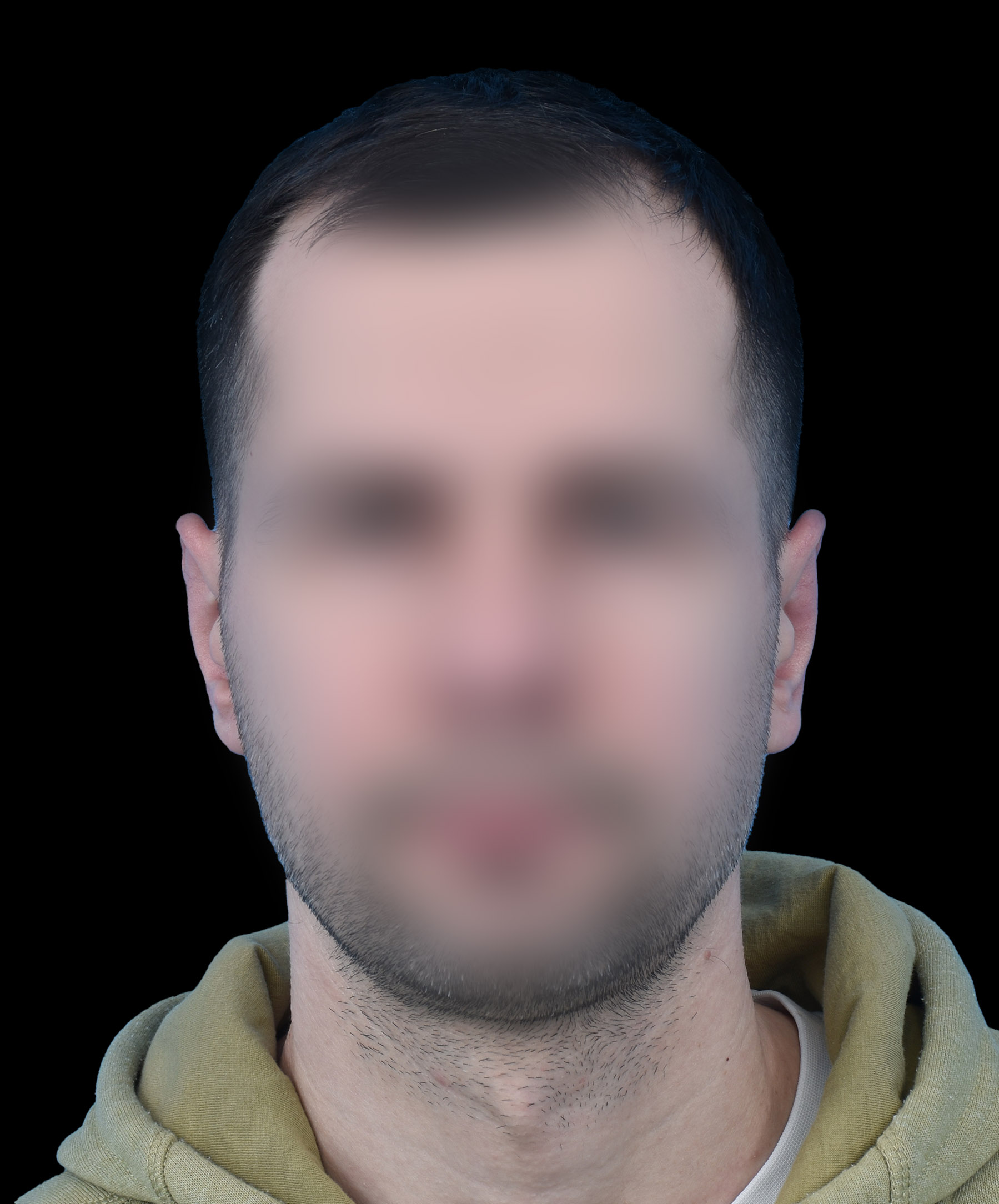 Symetria uszu po korekcji odstających uszu wykonanej przez dr Kołacza we Wrocławiu