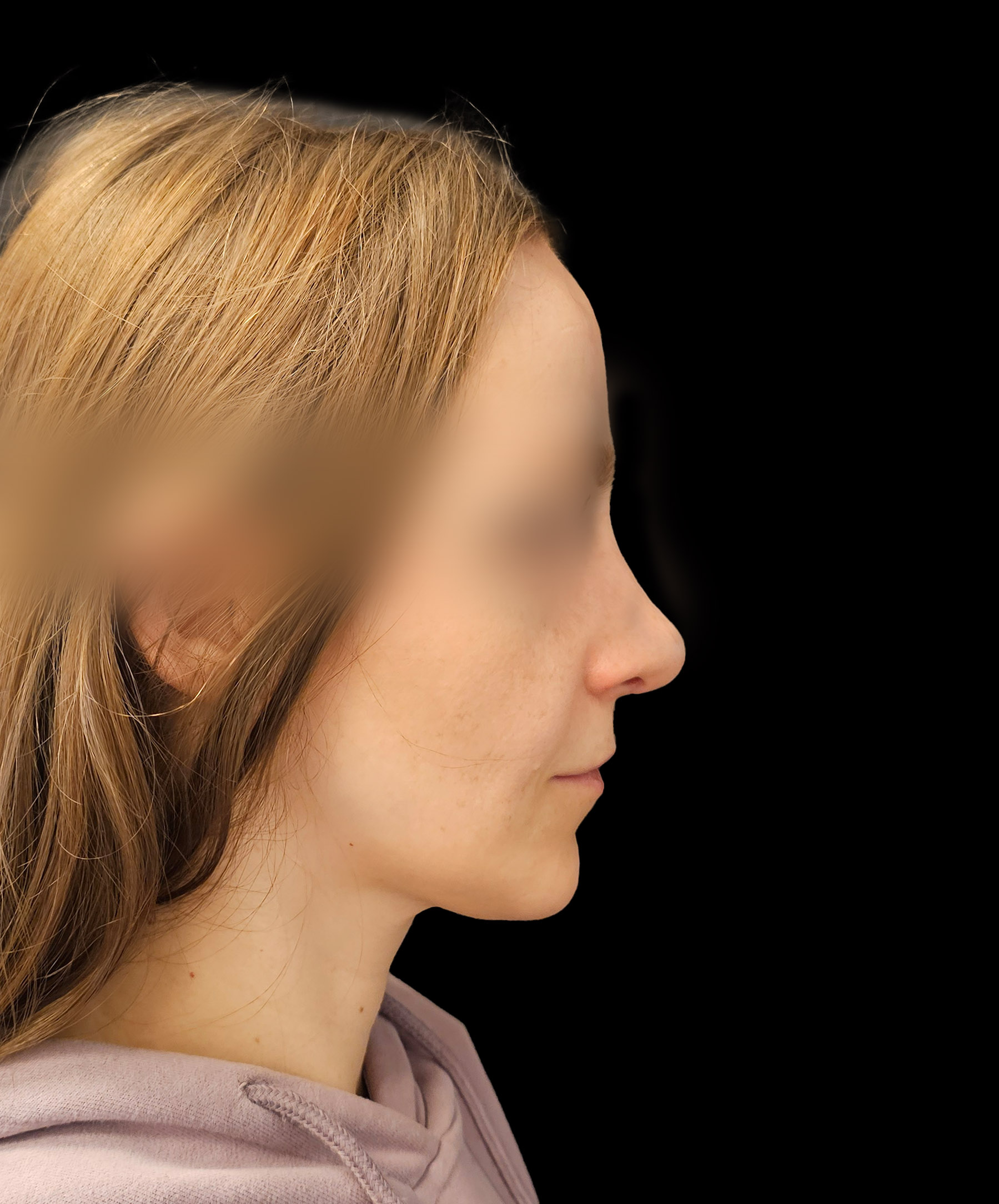 Profil po usunięciu garbu nosa wykonanym przez dr Kołacza we Wrocławiu