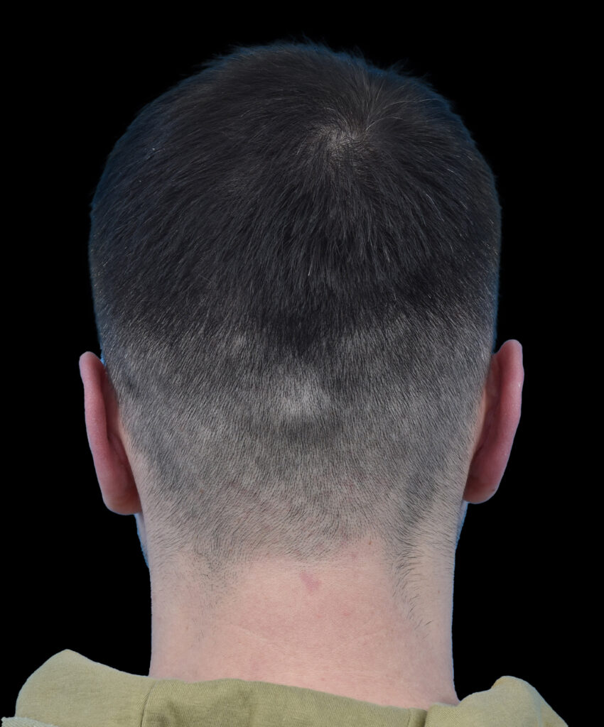 Stan po plastyce uszu Wrocław