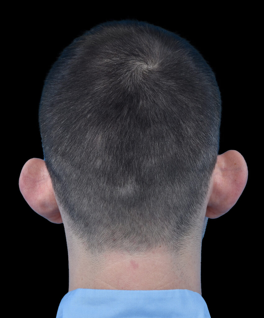 Odstające uszy Wrocław