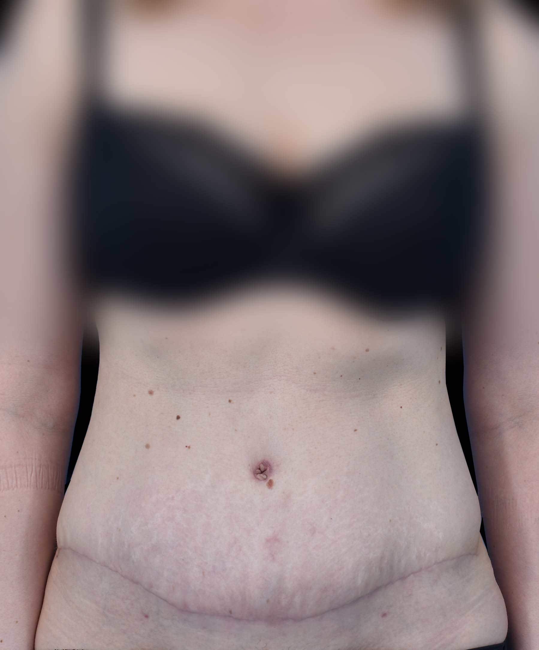 Płaski brzuch po abdominoplastyce wykonanej przez dr Kołacza we Wrocławiu
