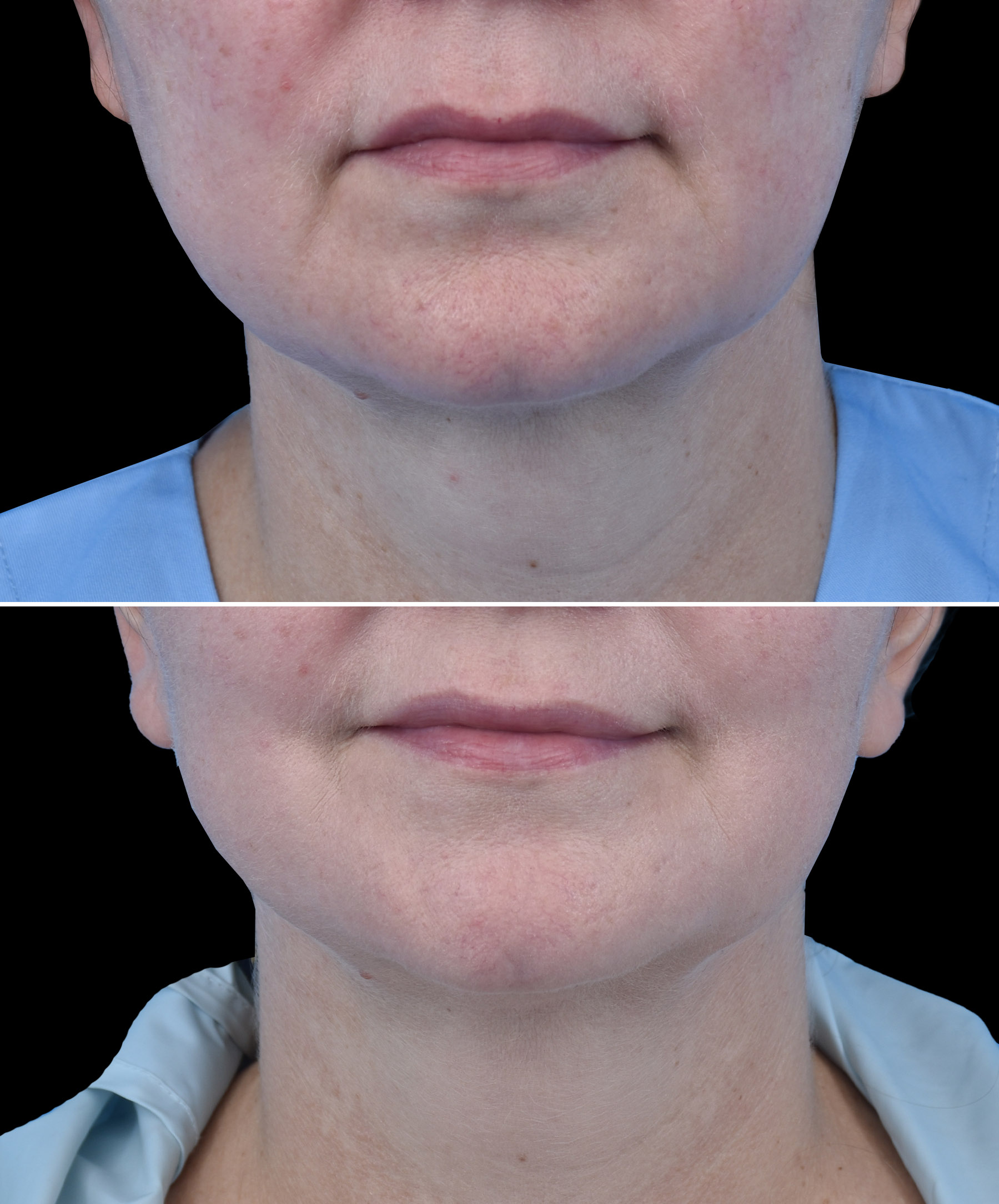 Efekt odmłodzenia twarzy po liftingu wykonanym przez dr Kołacza we Wrocławiu