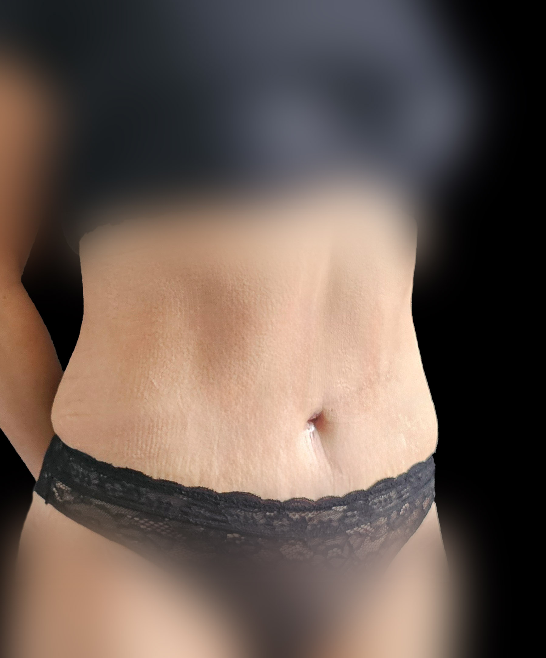 Modelowanie talii po plastyce brzucha wykonanej przez dr Kołacza we Wrocławiu