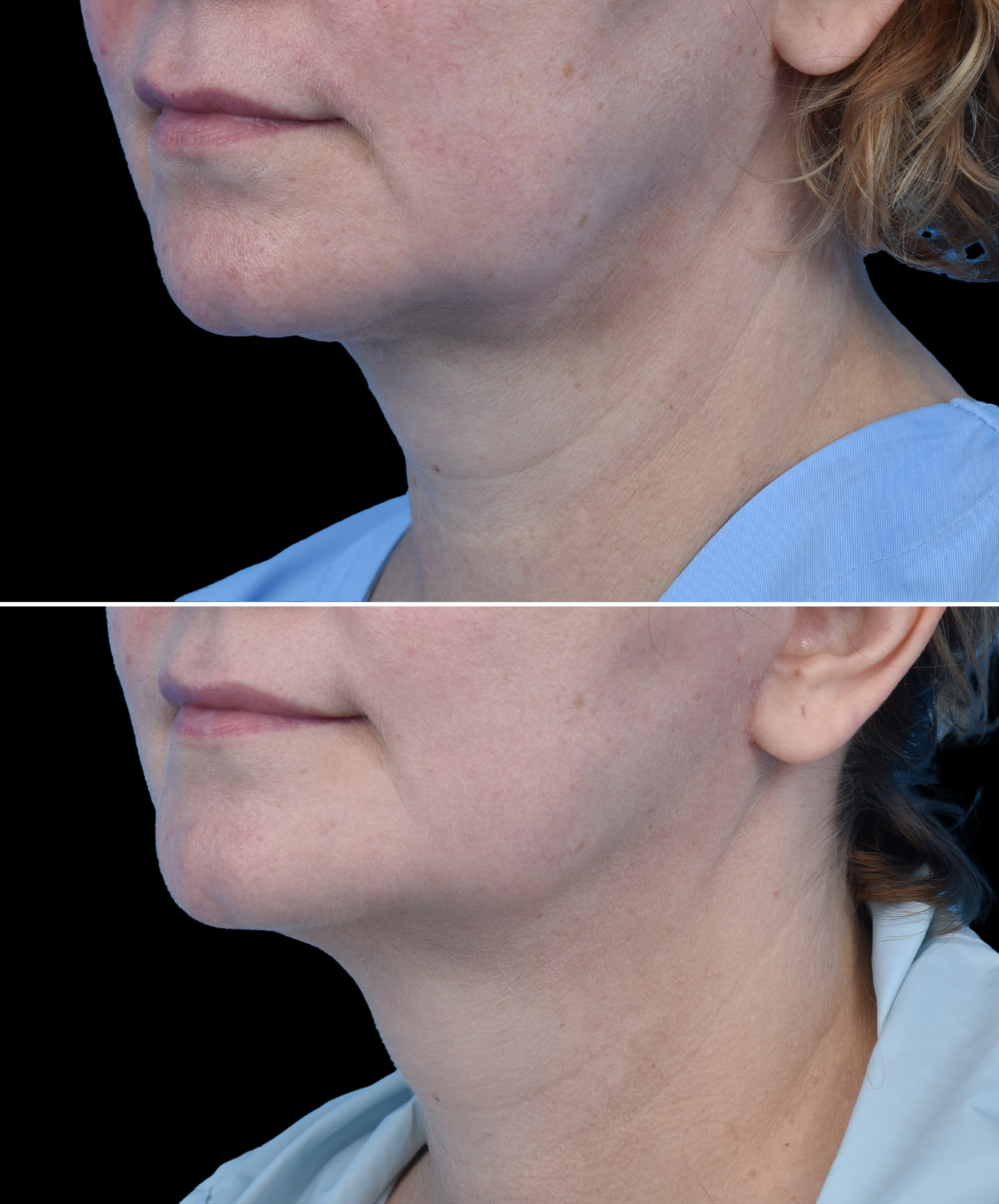 Napięta skóra twarzy po facelift dr Kołacz Wrocław