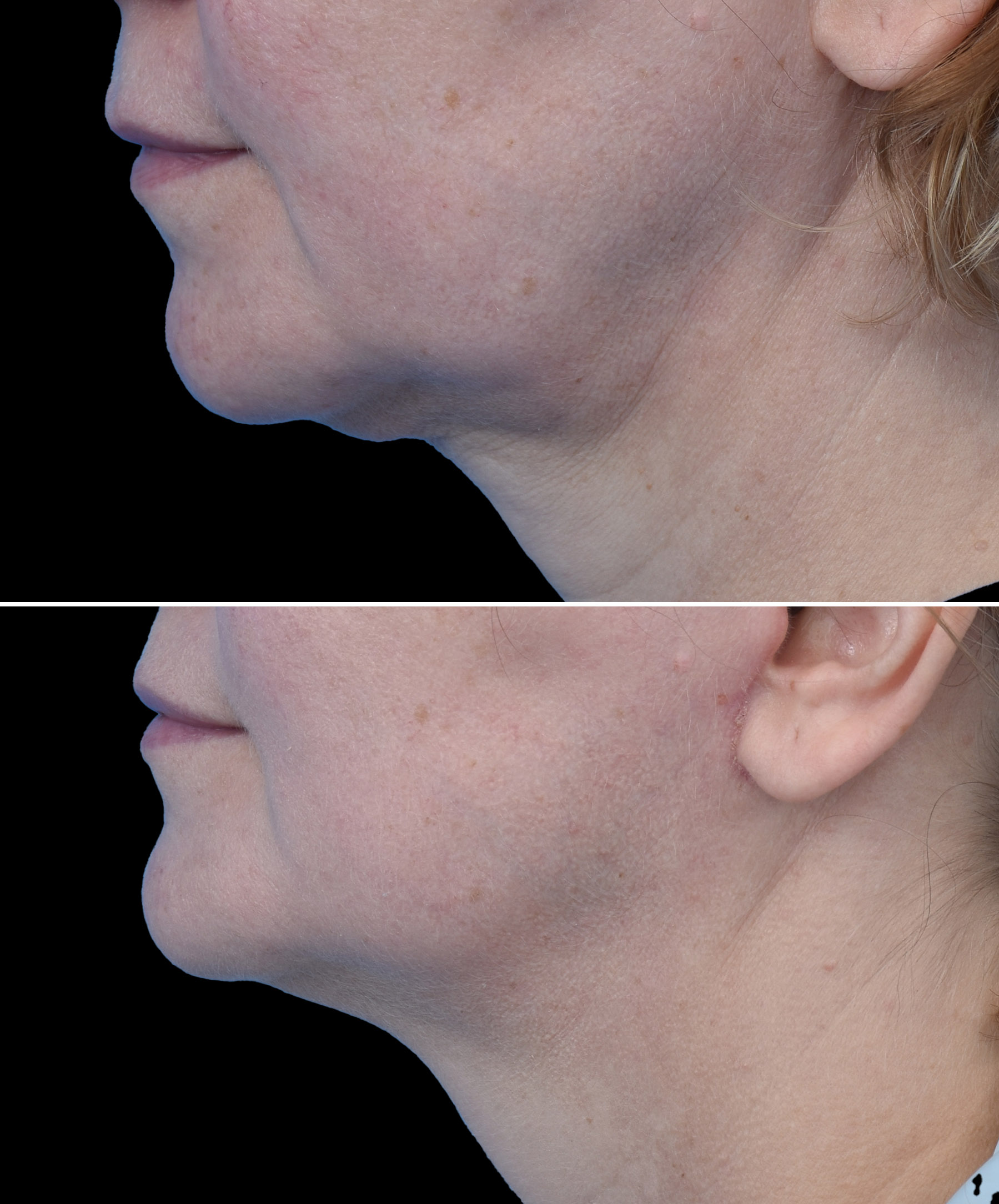 Naturalny efekt po liftingu twarzy wykonanym przez dr Kołacza we Wrocławiu