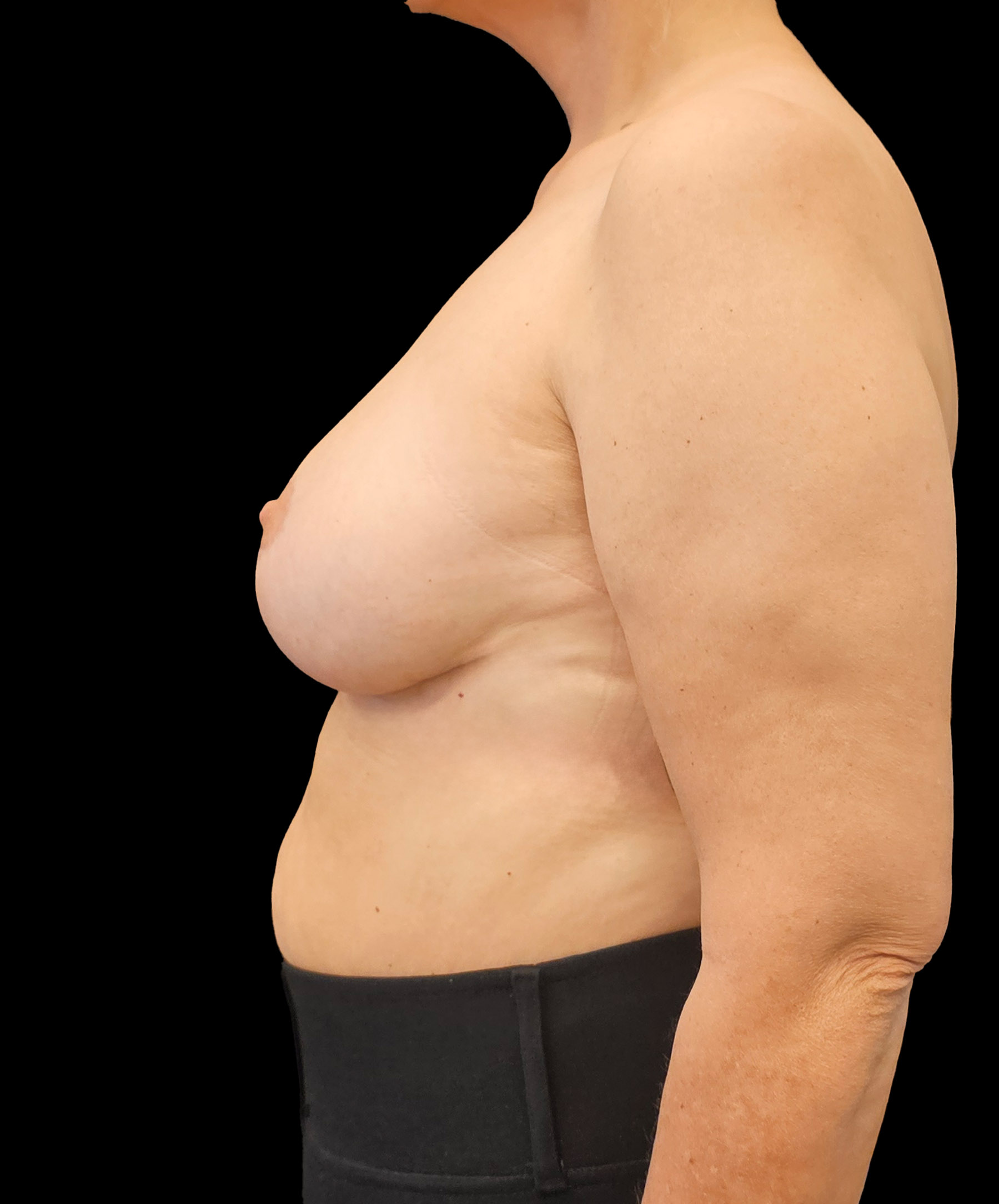 Naturalny efekt po zmniejszeniu biustu dr Kołacz Wrocław