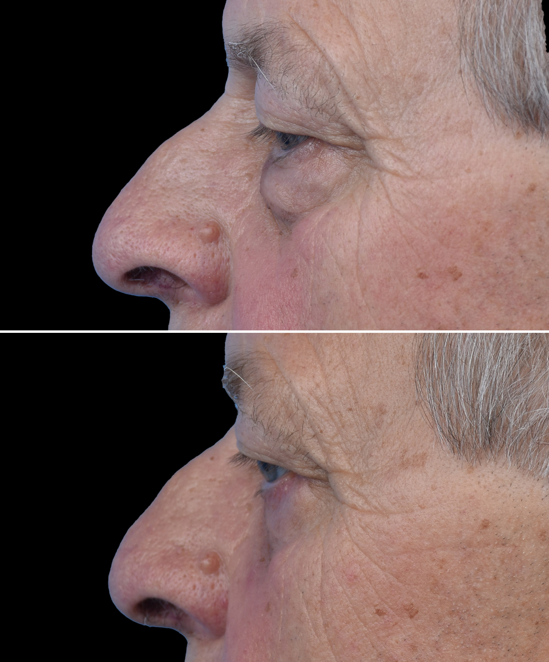 Efekt plastyki powiek dolnych wykonanej przez dr Kołacza Wrocław widok en face