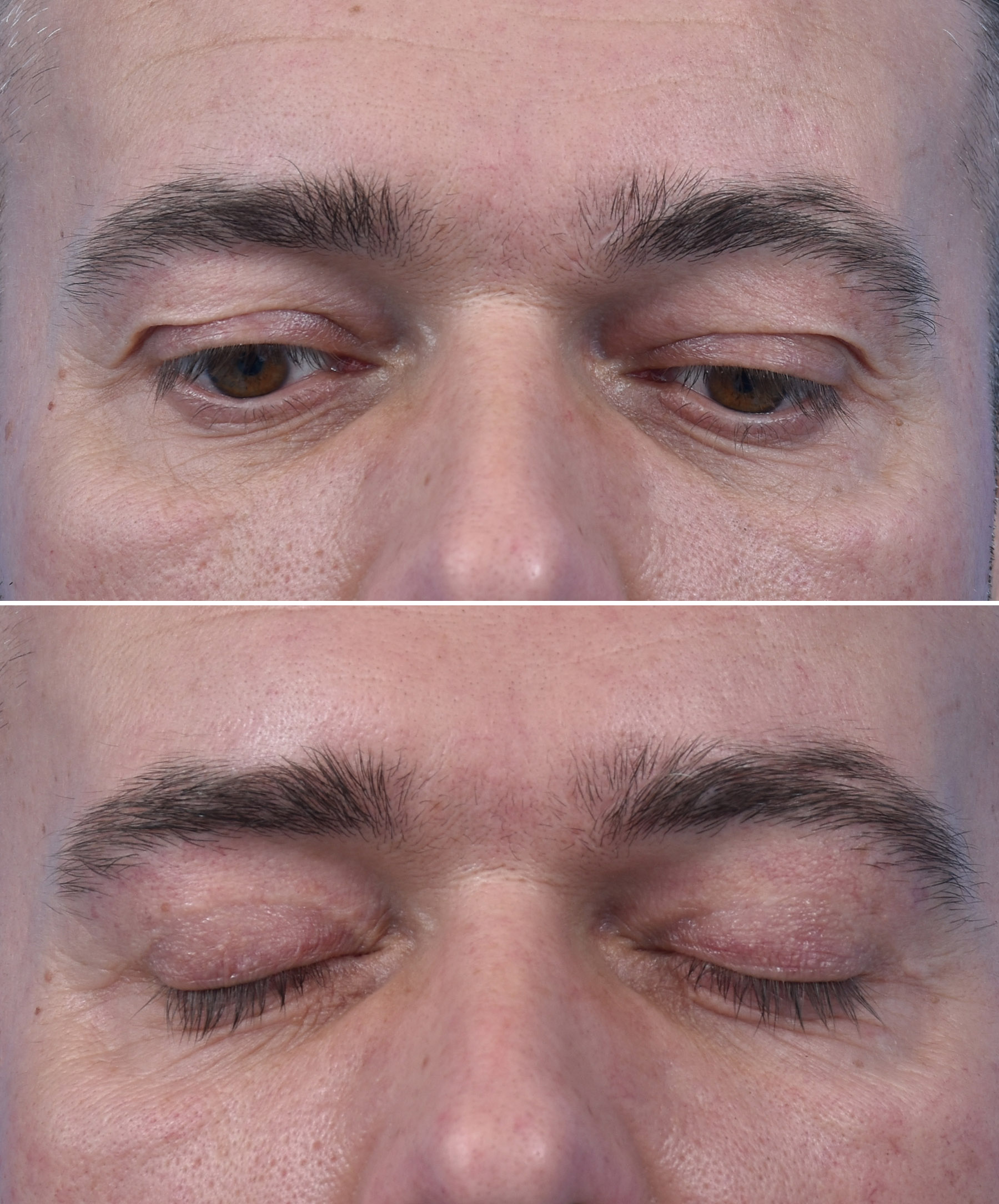 Efekt plastyki powiek górnych u mężczyzny wykonanej przez dr Kołacza we Wrocławiu