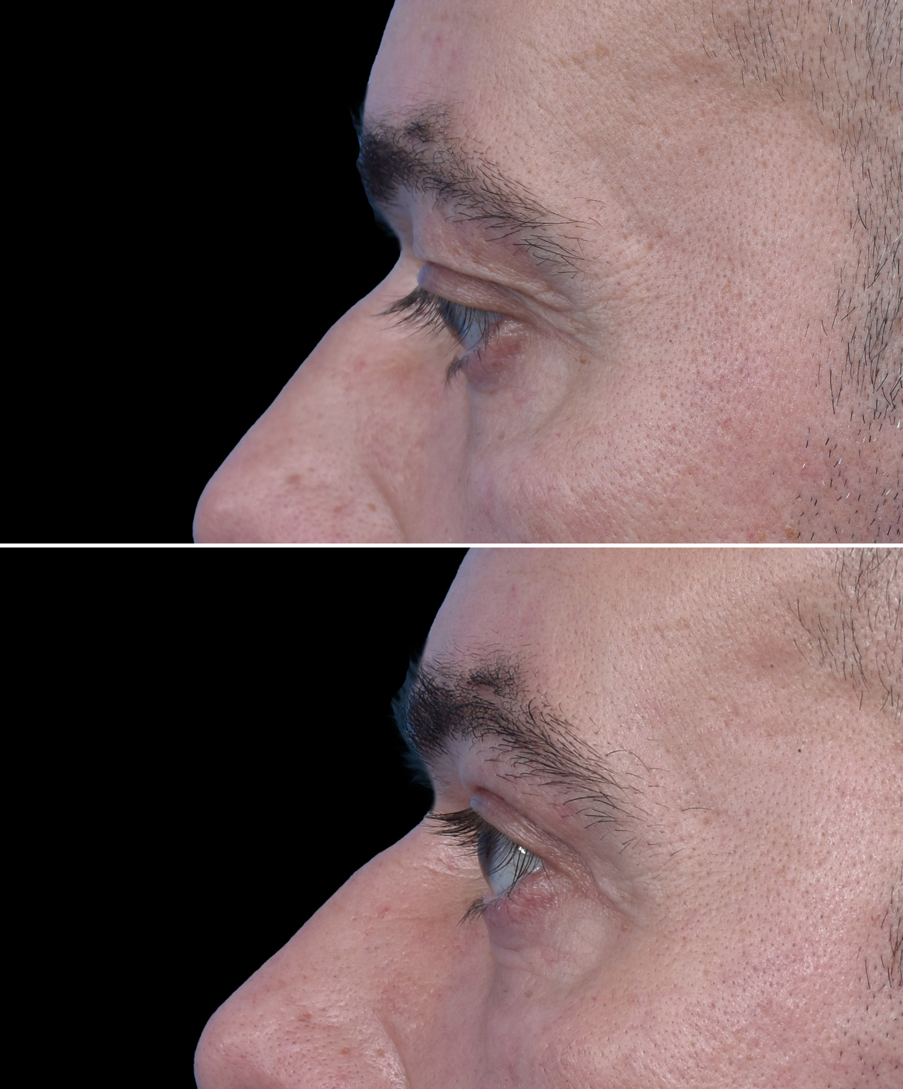 Efekt plastyki powiek górnych u mężczyzny wykonanej przez dr Kołacza Wrocław widok en face