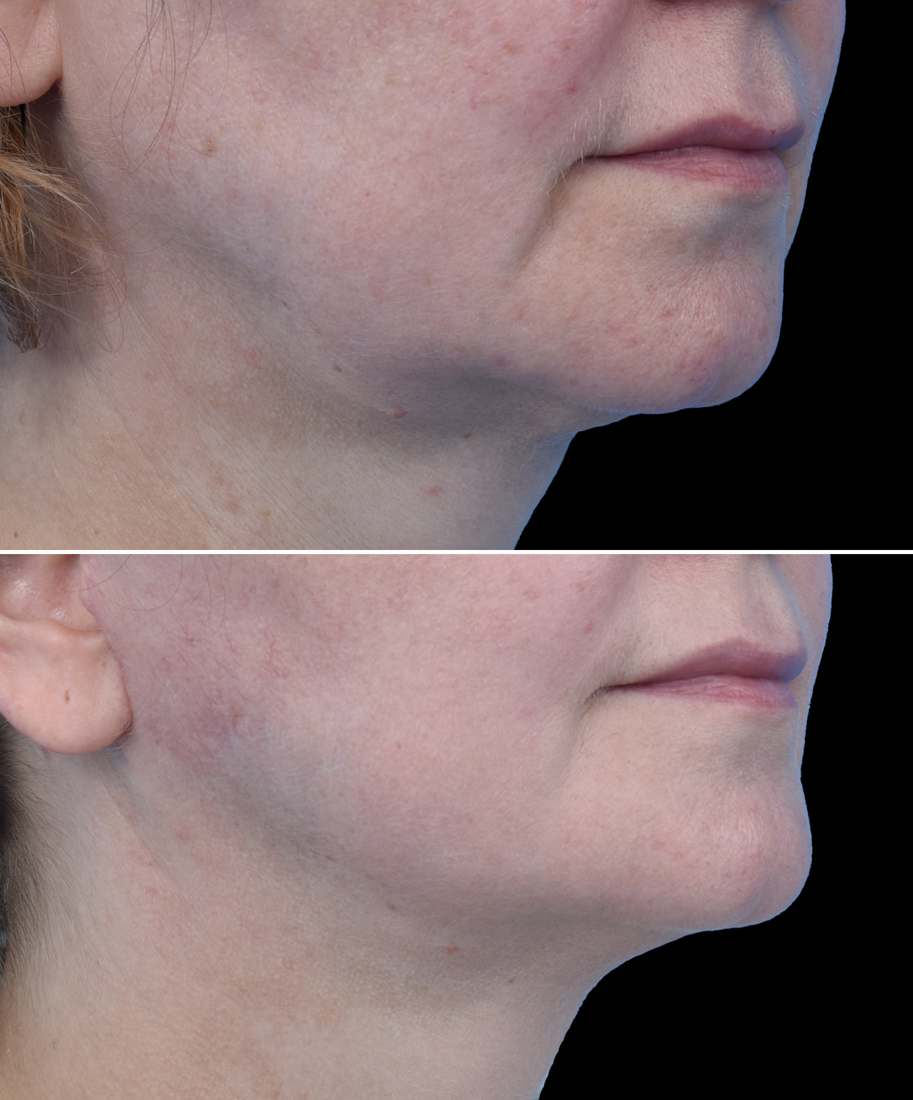 Linia żuchwy po liftingu twarzy dr Kołacz Wrocław