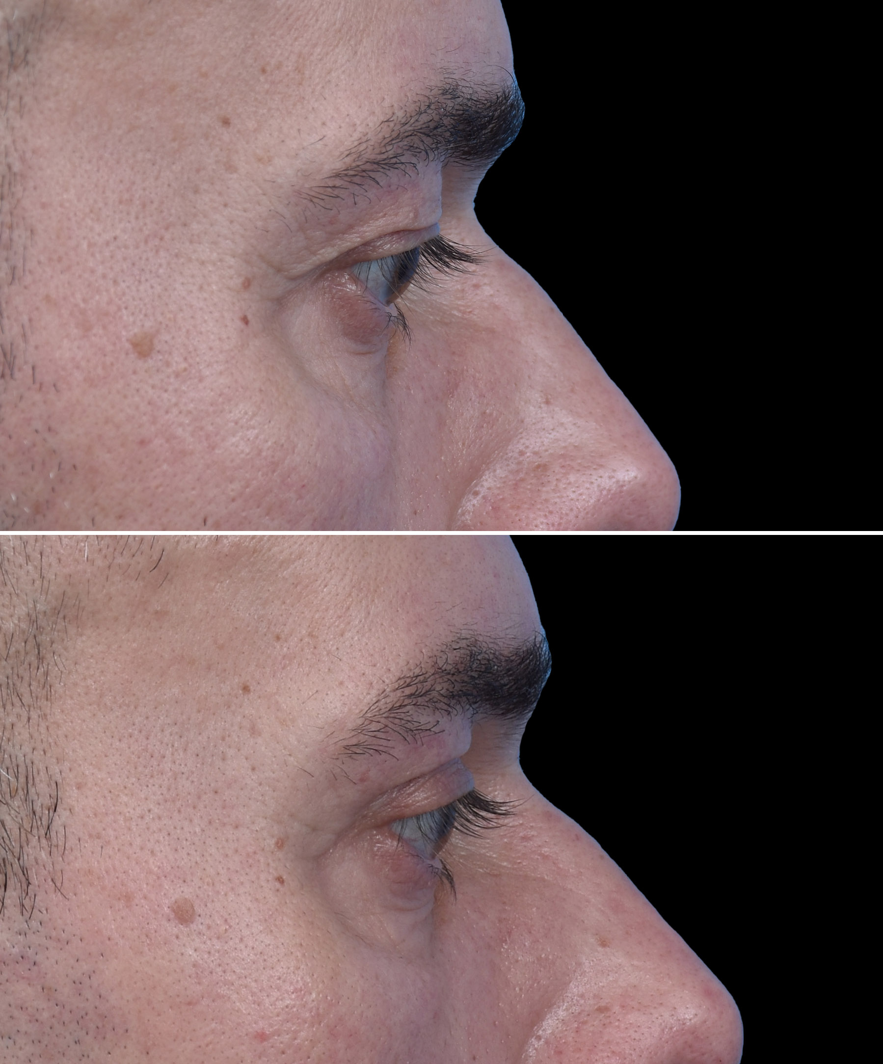 Usunięcie nadmiaru skóry powiek górnych u mężczyzny dr Kołacz Wrocław