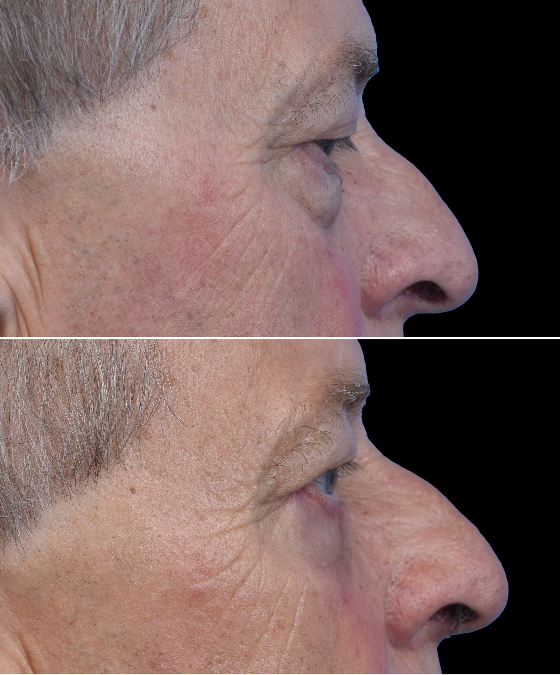 Usunięcie worków pod oczami po plastyce powiek dolnych dr Kołacz Wrocław