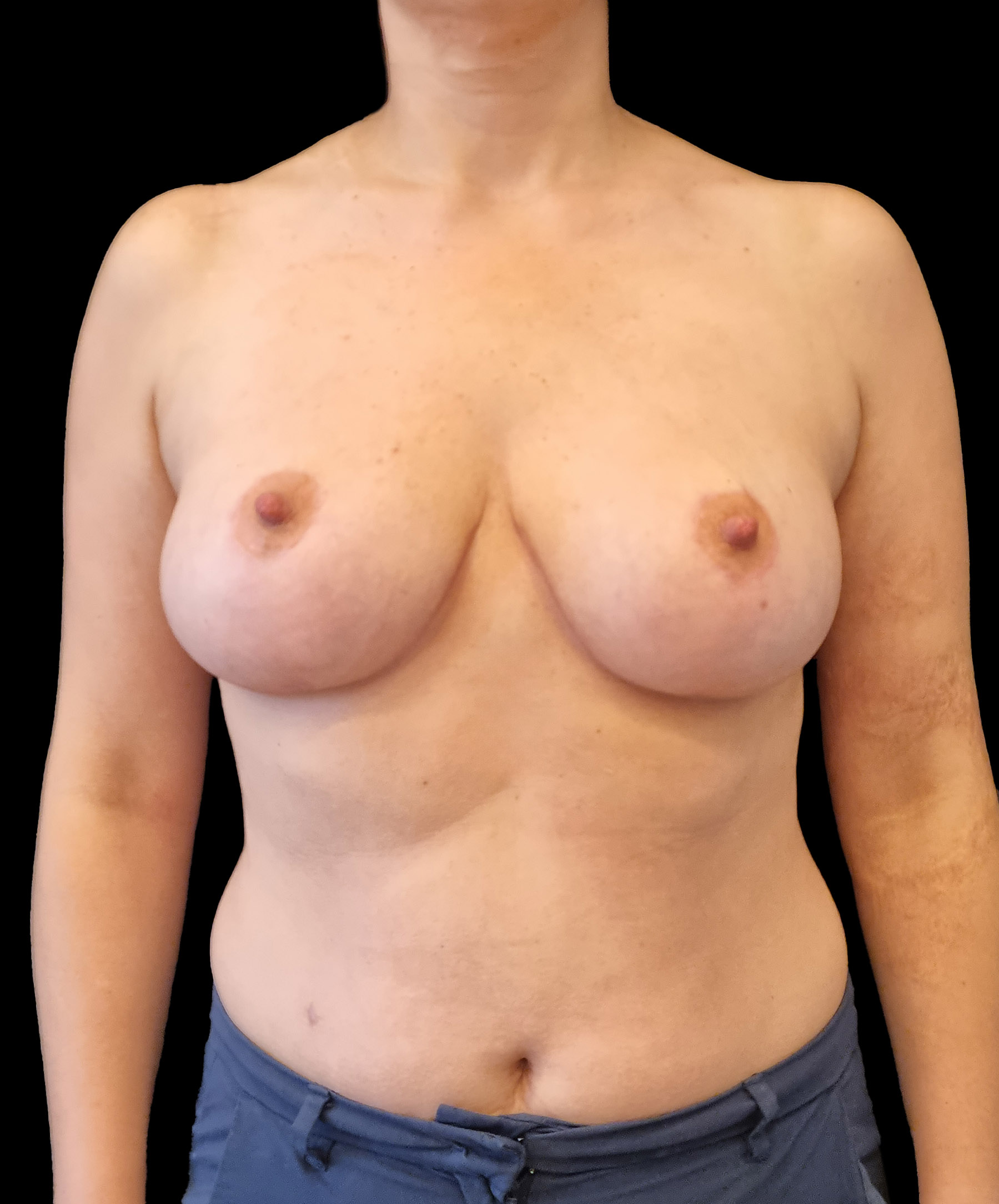 Efekt zmniejszenia piersi wykonanego przez dr Kołacza we Wrocławiu