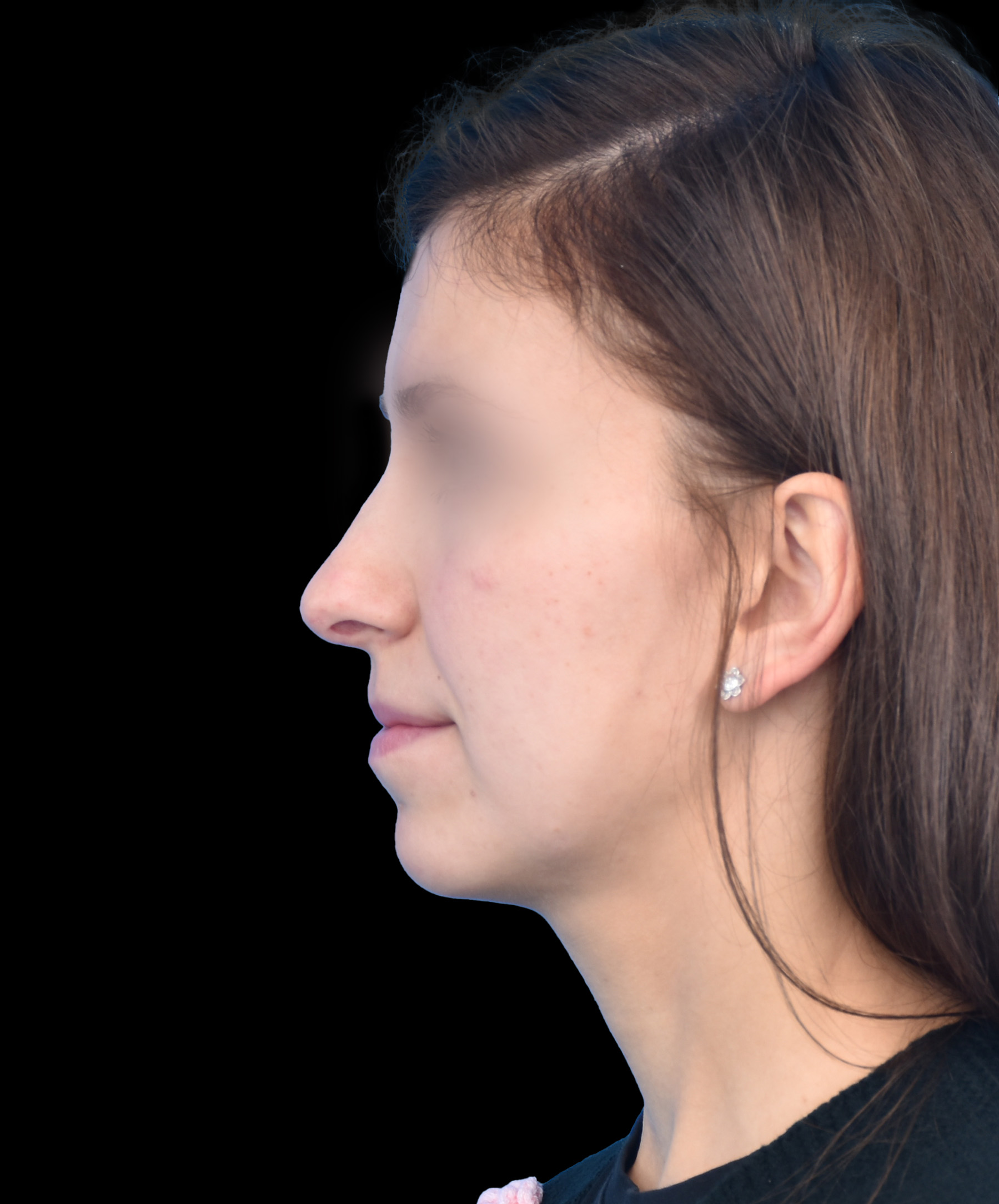 Profil po usunięciu garbu nosa i korekcji opadającego czubka dr Kołacz Wrocław
