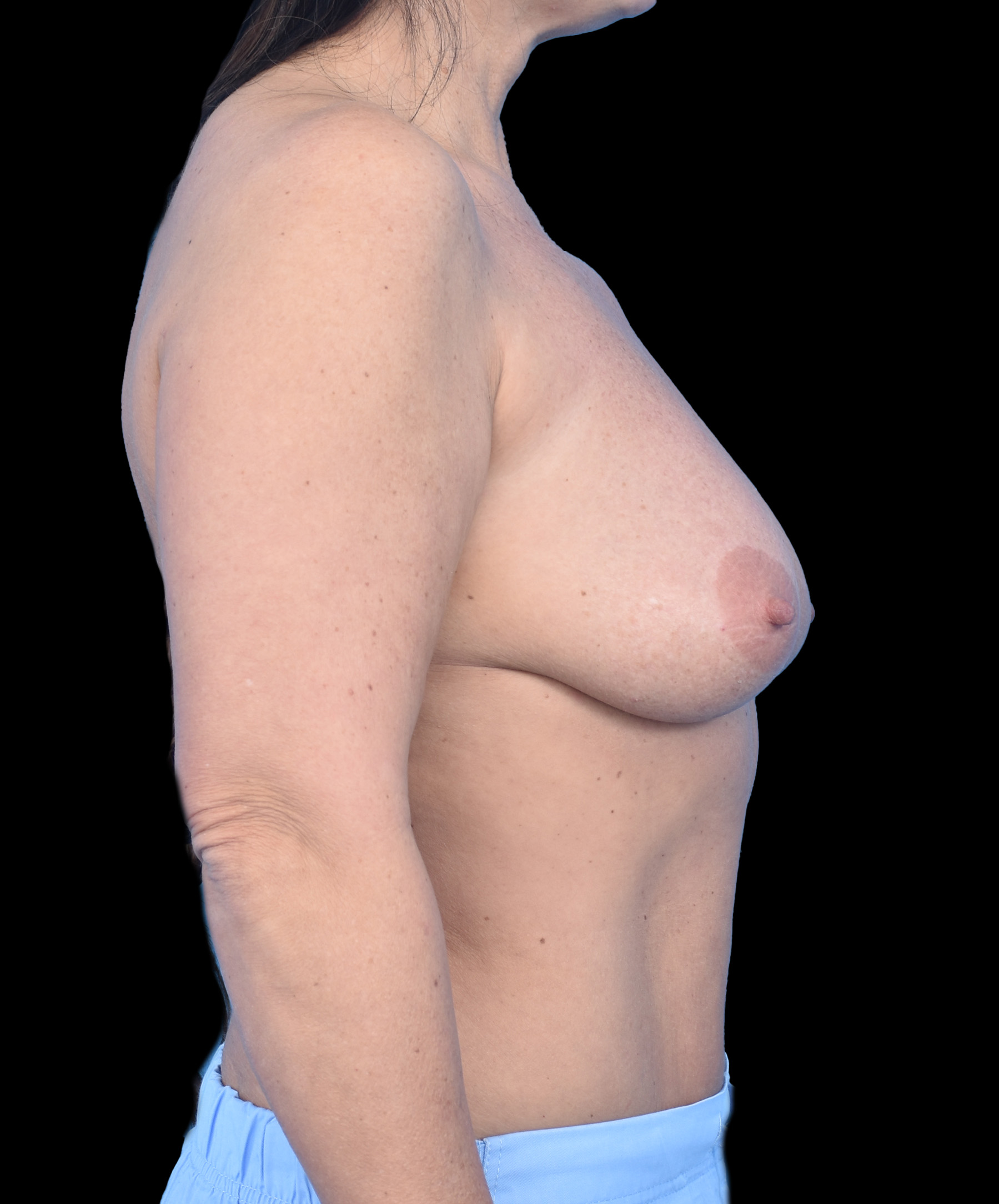 Podniesienie piersi z implantami Wrocław