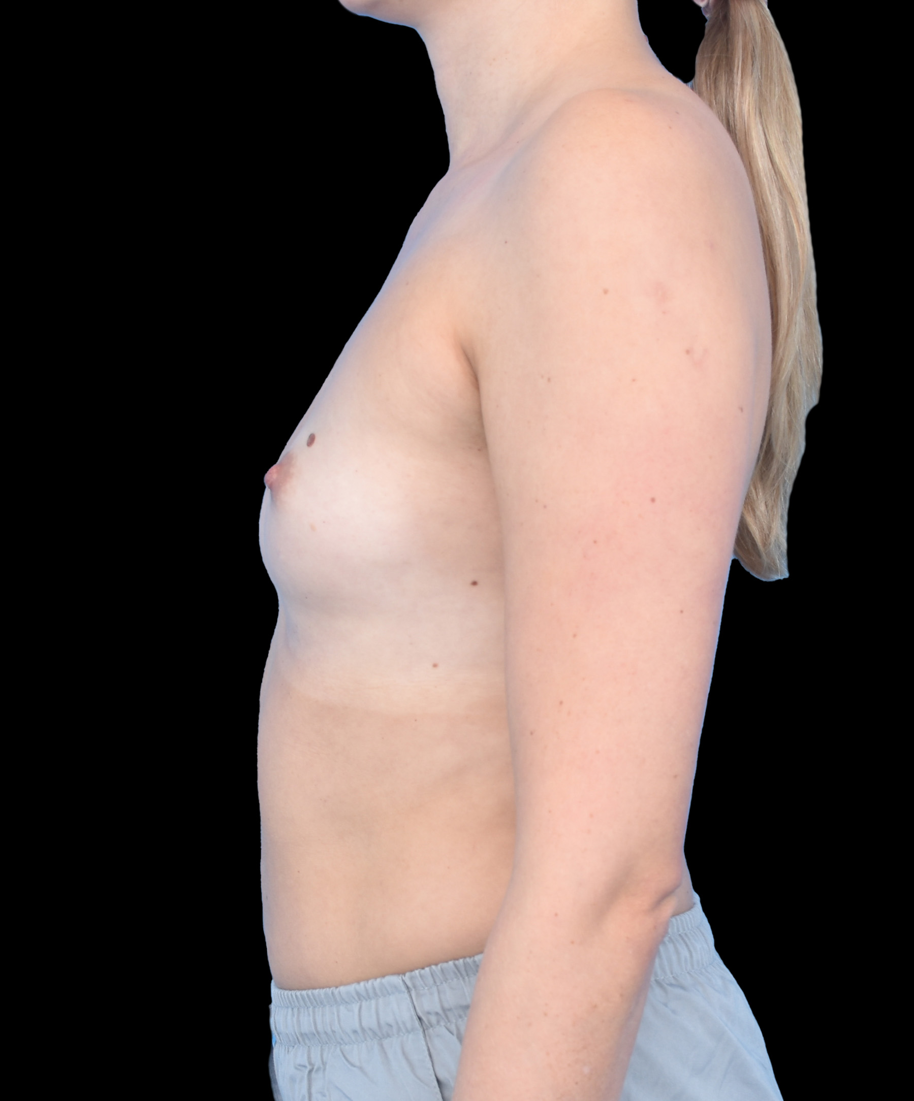 Powiększenie piersi w znieczuleniu miejscowym Wrocław