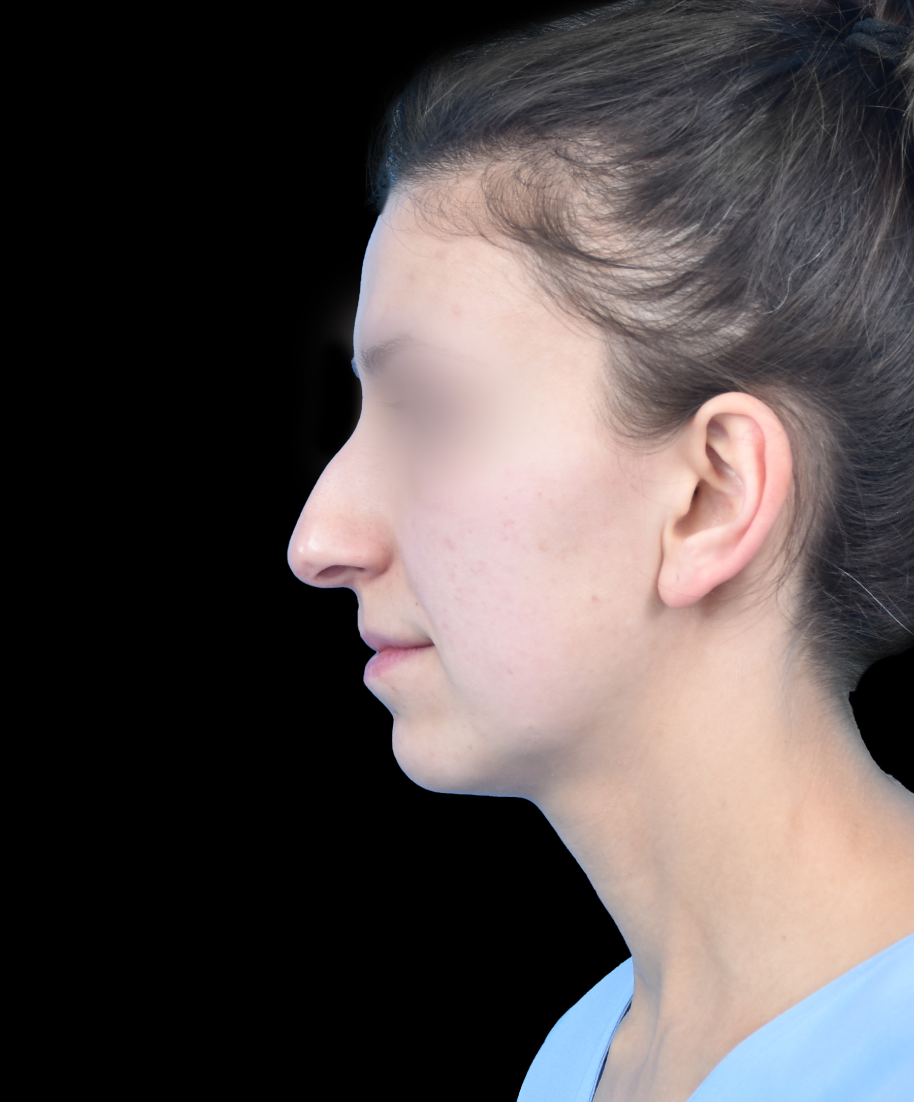 Zdjęcie przedstawia porównanie przed i po operacji korekcji nosa. Po lewej stronie widoczny jest nos pacjenta przed zabiegiem, z widocznymi nierównościami i asymetrią. Po prawej stronie efekt po operacji – nos ma prostszy kształt, jest bardziej symetryczny i harmonijnie dopasowany do rysów twarzy