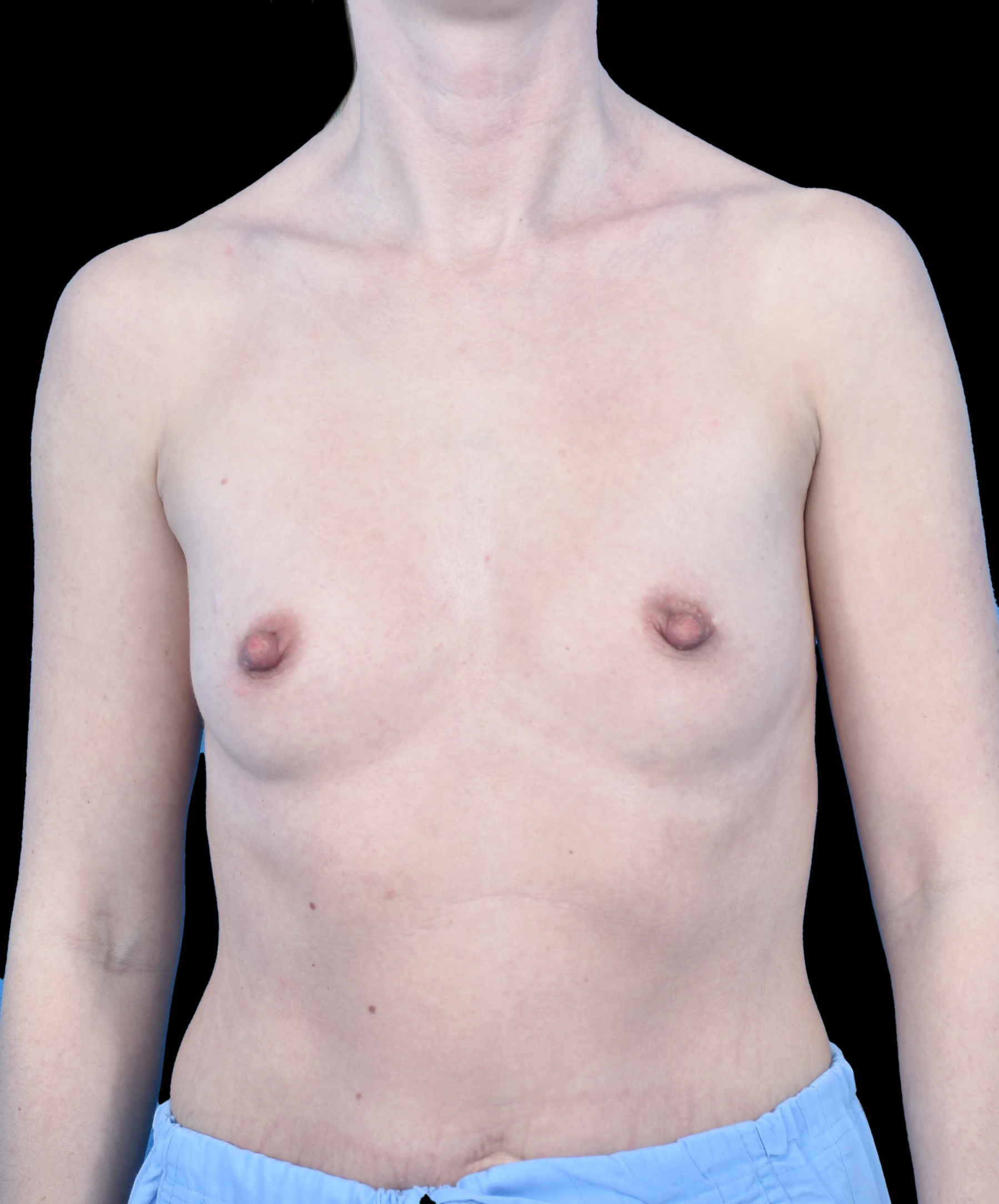 Efekt powiększenia piersi implantami wykonany przez dr Kołacza Wrocław widok en face