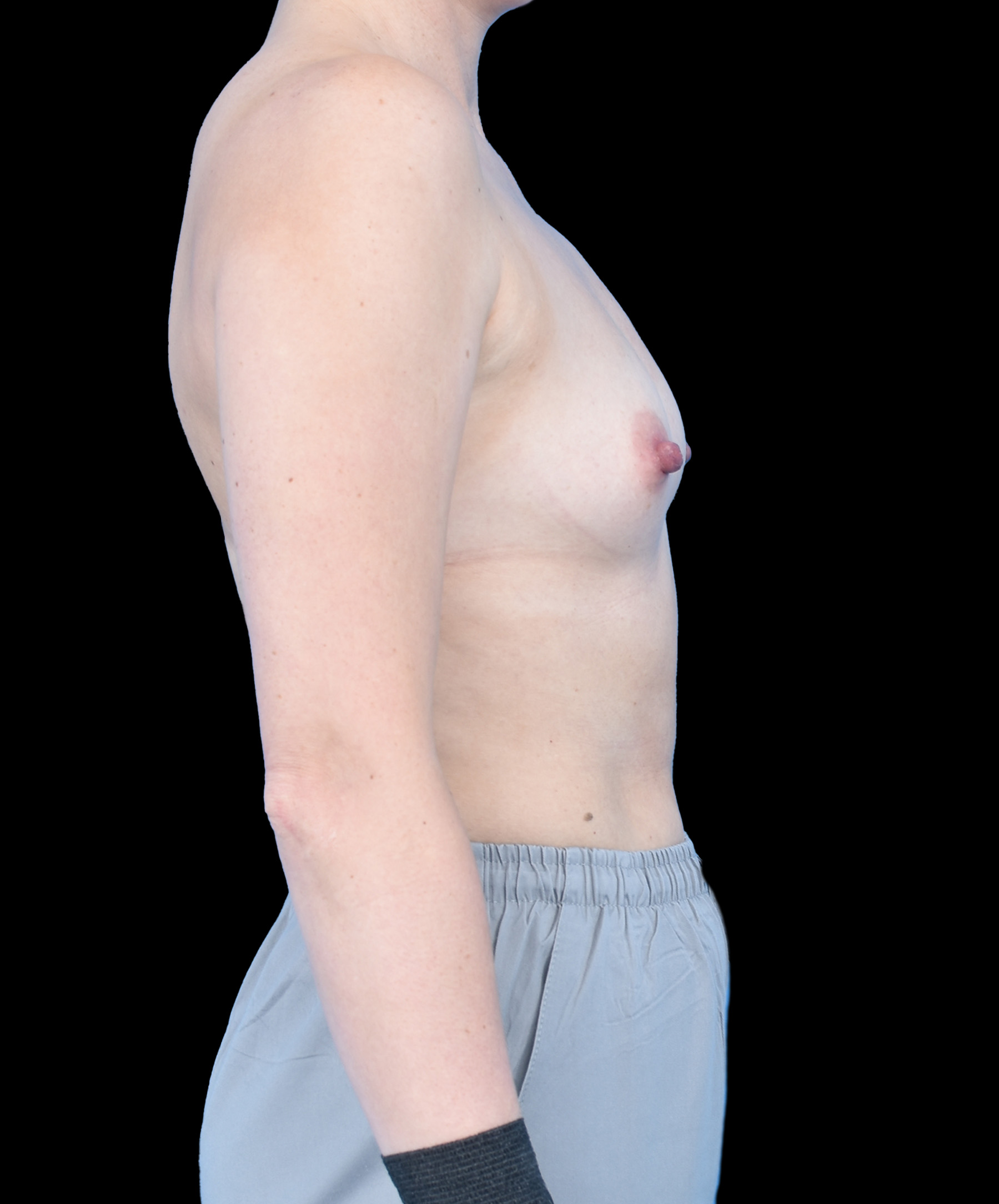 Harmonizacja piersi MIA Wrocław