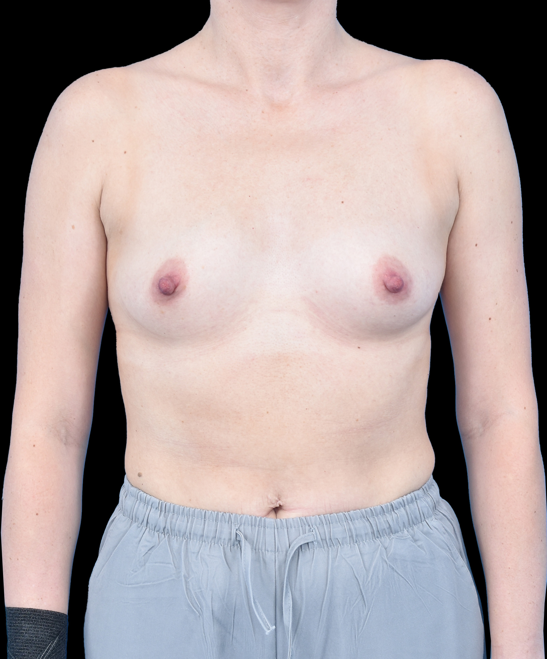 Harmonizacja piersi MIA Wrocław